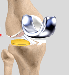 Osteotomy & Uni-compartmental knee Arthroplasty