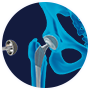 Anterior Hip Replacement