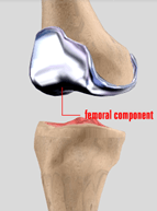 Minimally Invasive Total knee Replacement