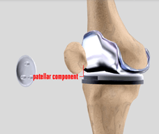 Minimally Invasive Total knee Replacement